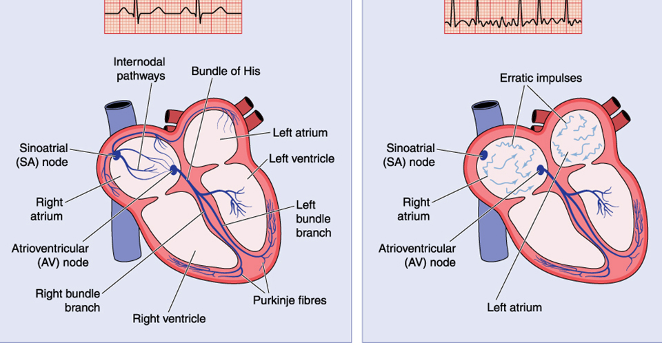 Spotlight on Pediatric Arrhythmia